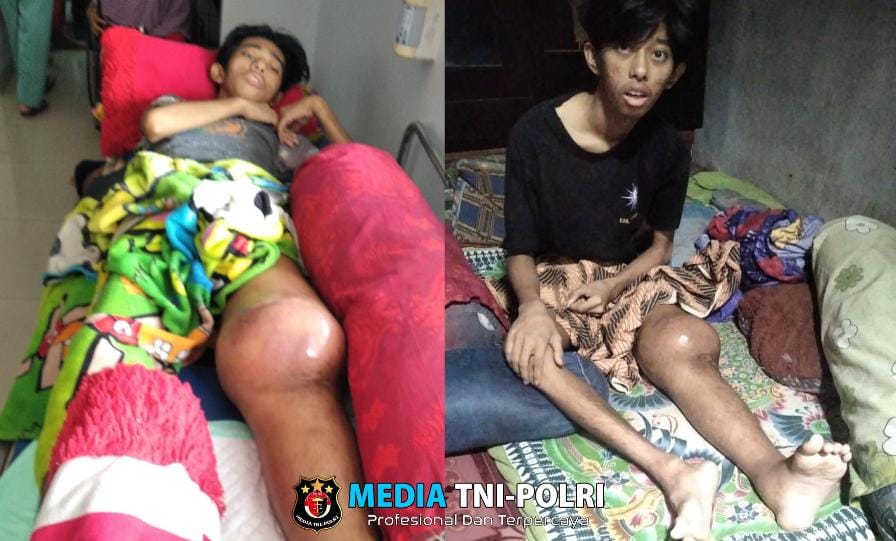 Pelajar SMAN 1 Kota Agung Tanggamus Divonis Kanker, Keluarga Kurang Mampu Butuh Bantuan