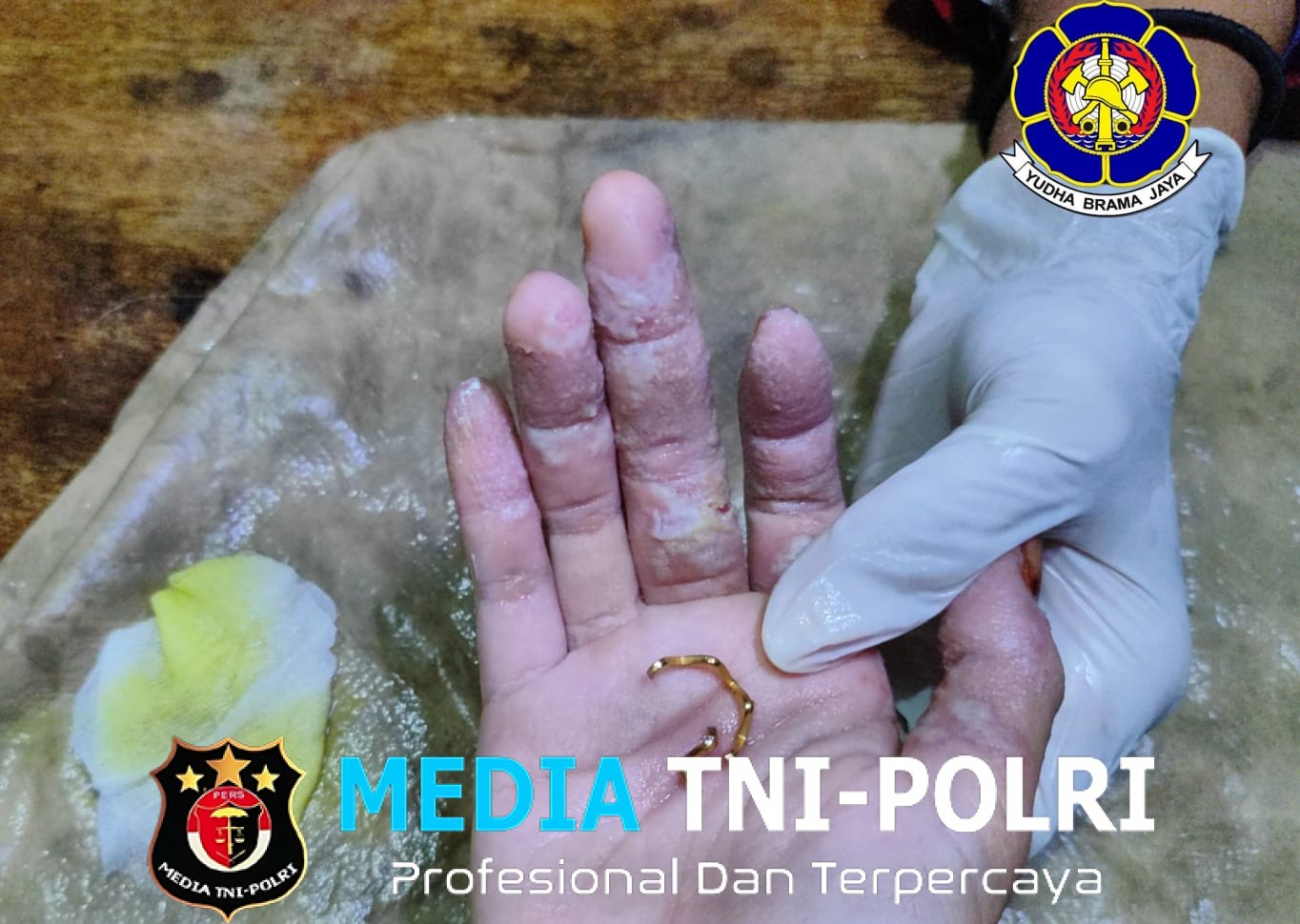 Cincin Tersangkut di Jari Tengah Anak, Damkar Kotim Lakukan Evakuasi